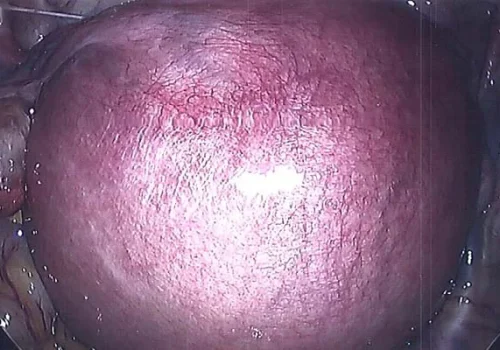 Large fibroid uterus seen at Laparoscopy