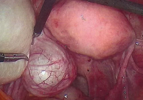 Large left Ovarian Cyst and smaller left para – tubal cyst