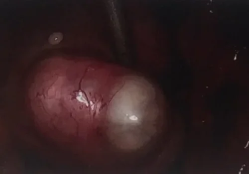 Large left dermoid cyst.