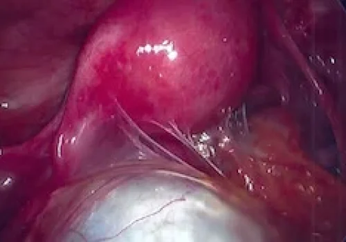 Large left ovarian cyst. There are significant adhesions involving bowel, ovaries and uterus