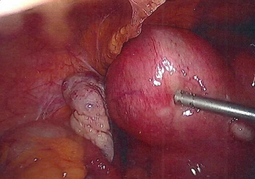 Large multi-fibroid uterus with normal left ovary