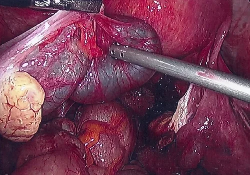 Large unruptured left Tubal Ectopic Pregnancy