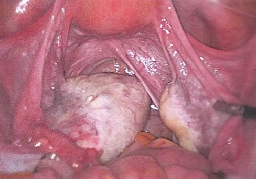 Left ovarian dermoid cyst