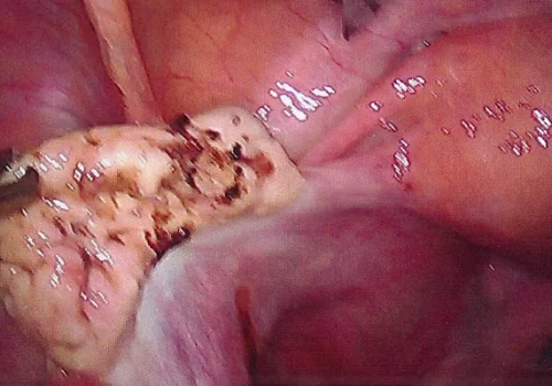 Left ovary after very careful diathermy of endometriosis