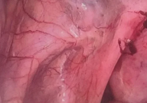 Left side wall endometriosis.