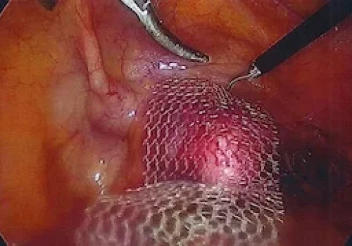 Mesh is laid over anterior vagina