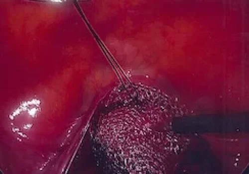 Mesh is sutured to anterior and posterior vagina