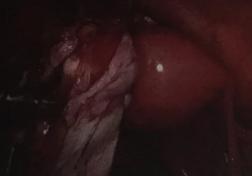 Normal ovarian tissue is carefully preserved and ongoing remodelling of the left ovary will continue.