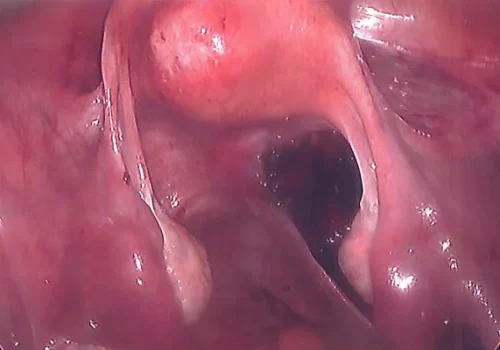 Normal pelvis at the end of the procedure.