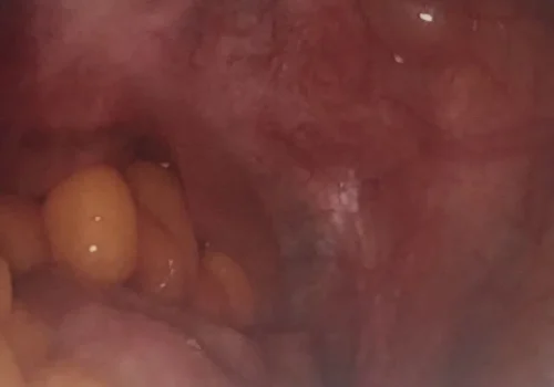 Normal pelvis at the end of the procedure.