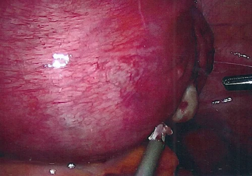 Normal right ovary next to pregnant uterus