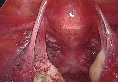 Ongoing healing of the left Ovary will continue. The normal right Ovary is seen here.