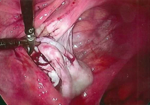 Ongoing remodeling of the left ovary will occur over the next few weeks.