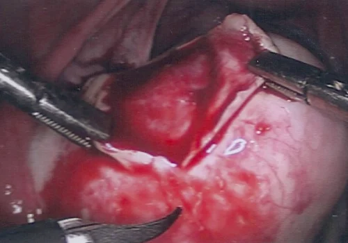 Opening the ovarian tissue to reveal the dermoid cyst