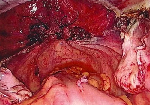 Pelvis at the end – the vaginal vault is closed with laparoscopic sutures..