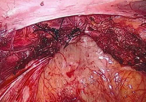 Pelvis at the end – the vaginal vault is closed with laparoscopic sutures