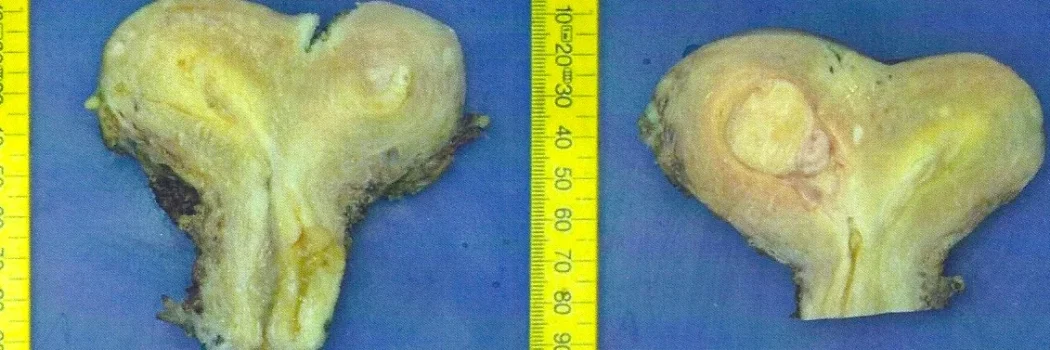Picture of the uterus showing double uterus. There is a fibroid extending into the cavity on the right (submucosal fibroid).