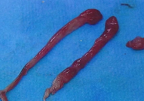 Pictures of Endometrial Polyps