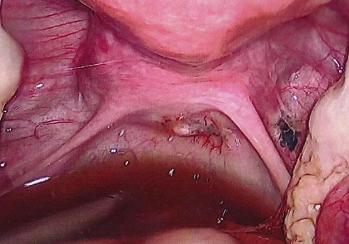 Pigmented endometriosis in Pouch of Douglas and right Pelvic Side Wall
