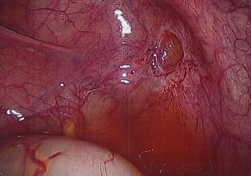 Pigmented endometriosis on Left Uterosacral Ligament