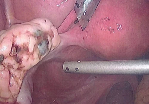 Pigmented endometriosis on left ovary