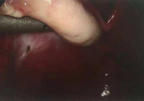 Pigmented endometriosis on left side wall. Normal left ovary is seen.