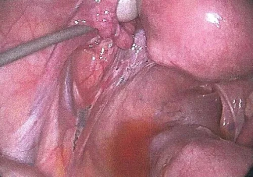 Pigmented endometriosis on the Left Pelvic Side Wall and over the left ureter