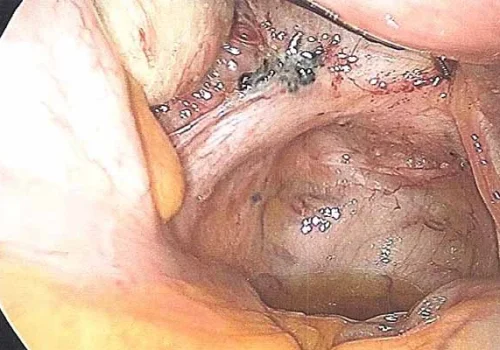 Pigmented nodule of endometriosis on left pelvic side wall and left Uterosacral Ligament