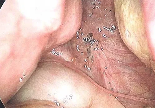 Pigmented nodule of endometriosis on right pelvic side wall