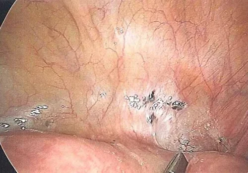 Pigmented nodule of endometriosis on surface of bladder