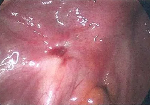 Rectal endometriosis is pigmented pink. The bowel is adherent to posterior cervix