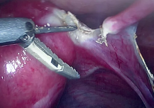 Removing right Fallopian Tube