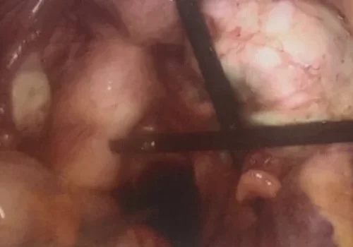 Right ovarian endometrioma and endometriosis of Pouch of Douglas.