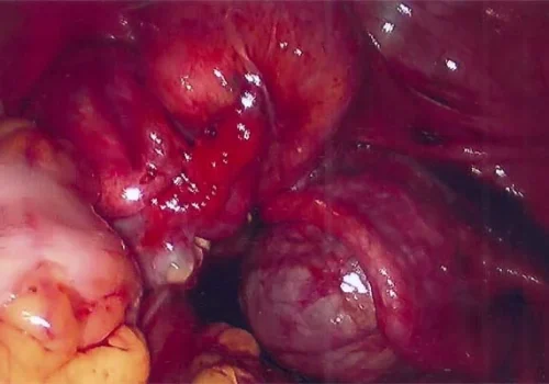 Right ovarian endometrioma is very adherent to right pelvic side wall