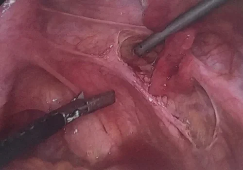 Right pelvic side wall endometriosis is excised.