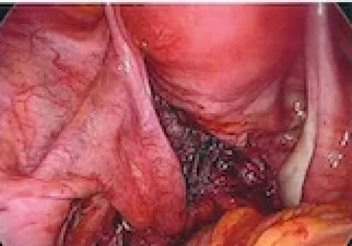 Showing a normal pelvis at the end. The right ovary is also see