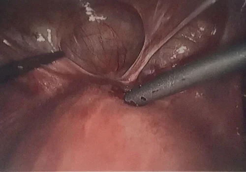 Significant scarring noted over the bladder.