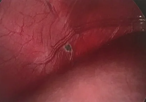 Small deposit of pigmented endometriosis on diaphragm. A prudent decision was made to not excise this..