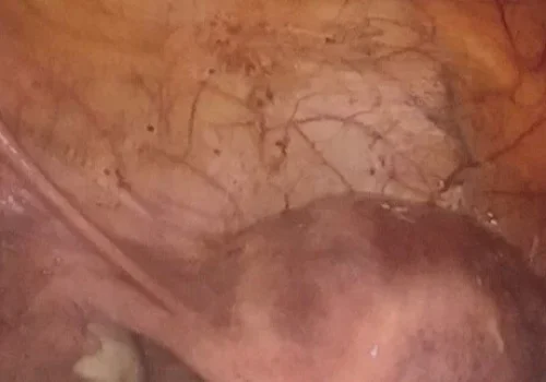 Superfical bladder Endometriosis.