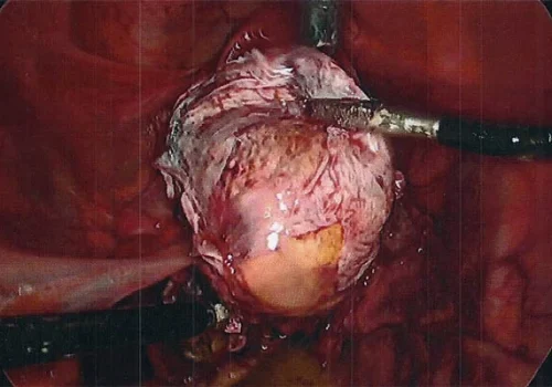 The Dermoid Cyst has been removed from the left Ovary.