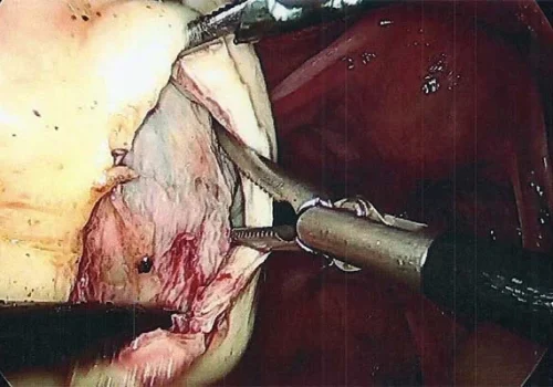 The Dermoid Cyst is dissected out from the normal ovarian tissue.