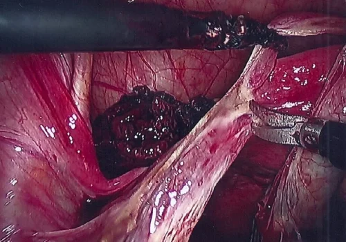 The Left Fallopian Tube is removed laparoscopically