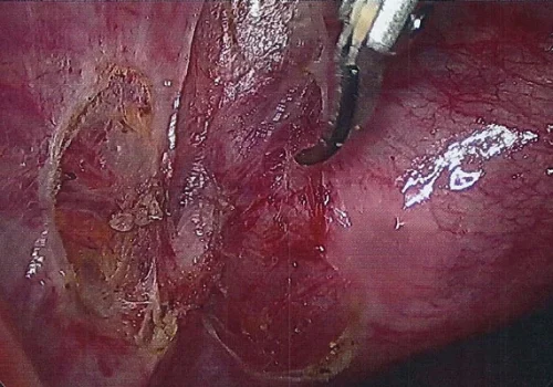 The Left Pelvic Side Wall at the end of the operation