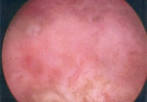 The Septum has been divided. The uterine cavity has opened up