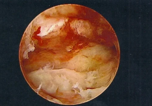The Uterine Cavity after removal of Endometrial Polyps