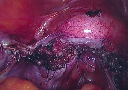 The Vaginal Vault has been sutured – at the end of the procedure