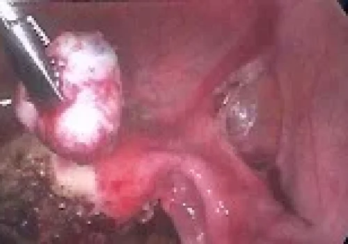 The adenomyoma is removed. This is seen on the left next to the uterus