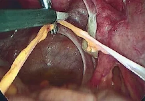 The adhesion is divided