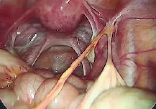 The adhesion is the band extending from the right pelvic side wall