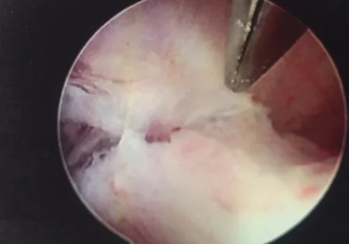 The adhesions are carefully divided using operating scissors.